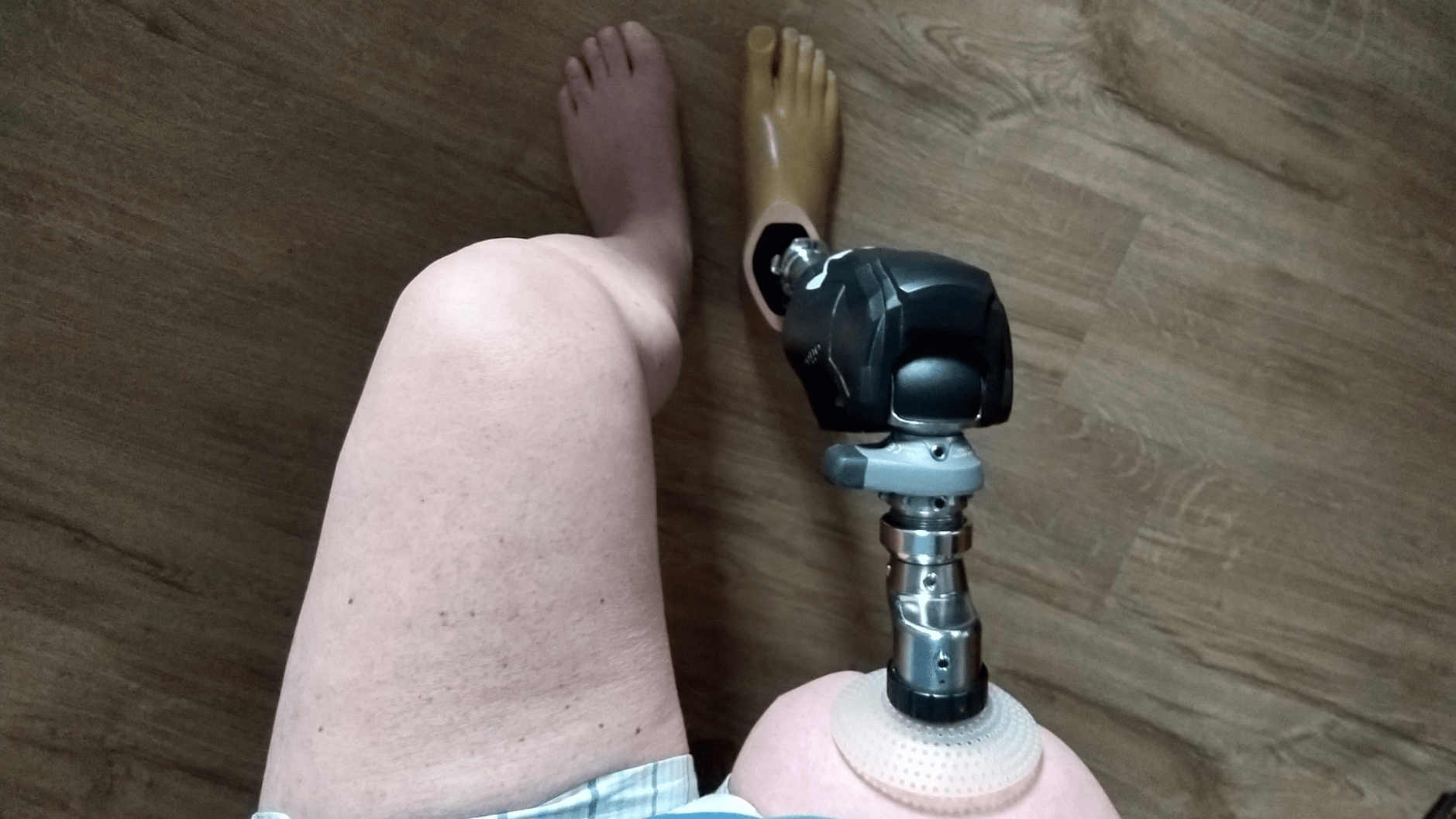 Endo-Exo Prothesenversorgung